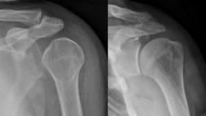 shoulder dislocation x-ray